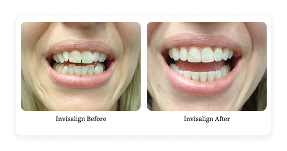 Before & After