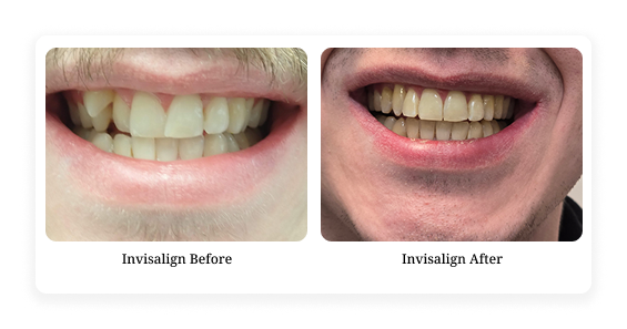 Before & After10
