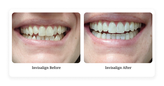 Before & After4